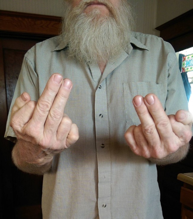 私の父は６本指の手を持っている。