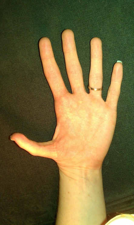 6本指手術後の手