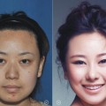 中国人の美容整形ビフォーアフター
