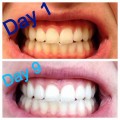 虫歯を治して歯を白くする上に他にも効果のある万能薬ココナッツオイル！