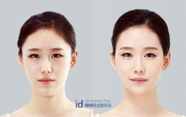 韓国の美容整形ビフォーアフター
